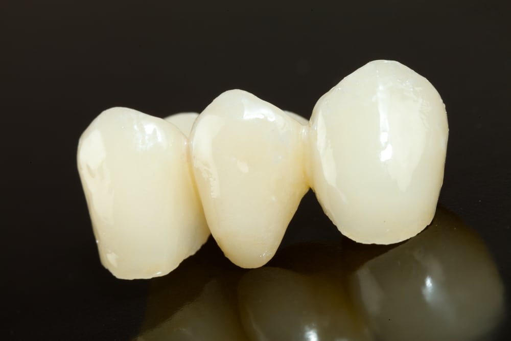 a set of dental bridges