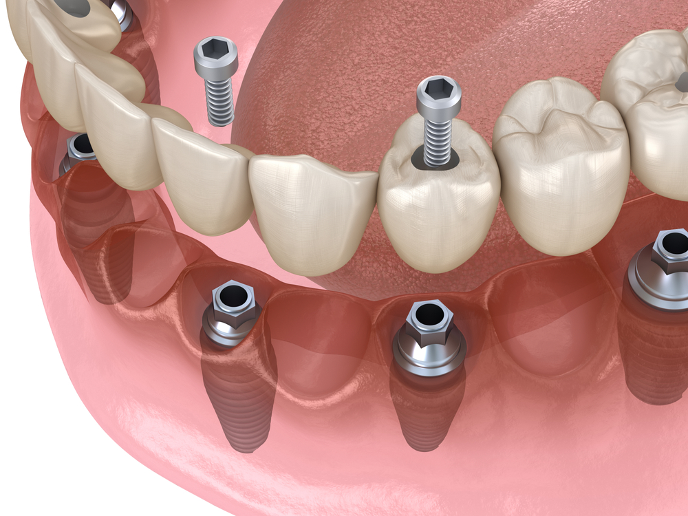 Digitally Guided Implants | Los Angeles, CA | Digital Denture + Implants