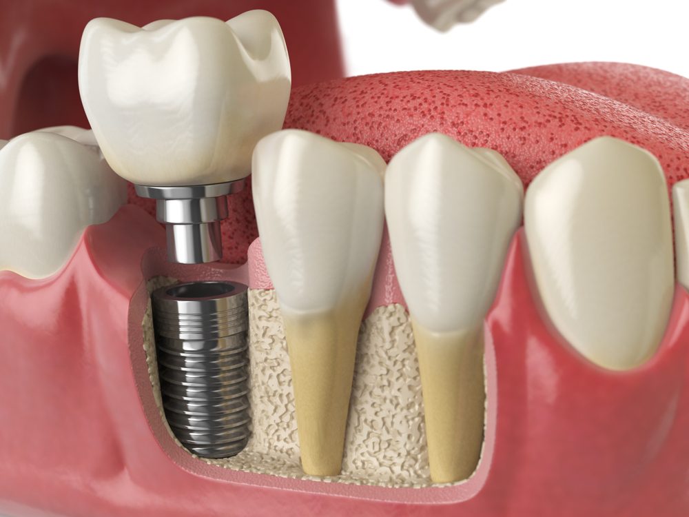 Digitally Guided Implants | Los Angeles, CA | Digital Denture + Implants