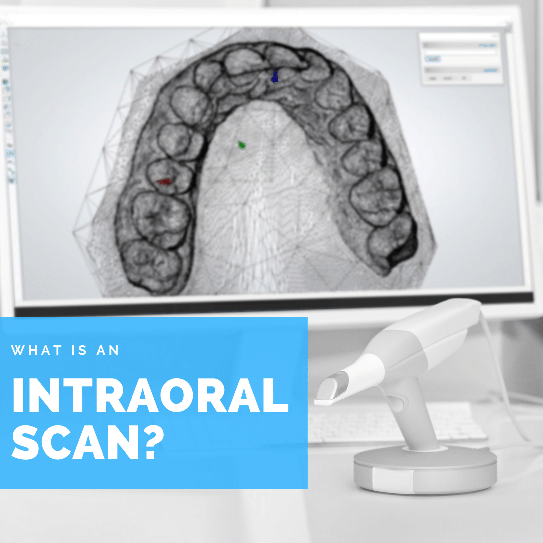 What is an Intraoral Scan? Digital Denture + Implants Los Angeles, CA