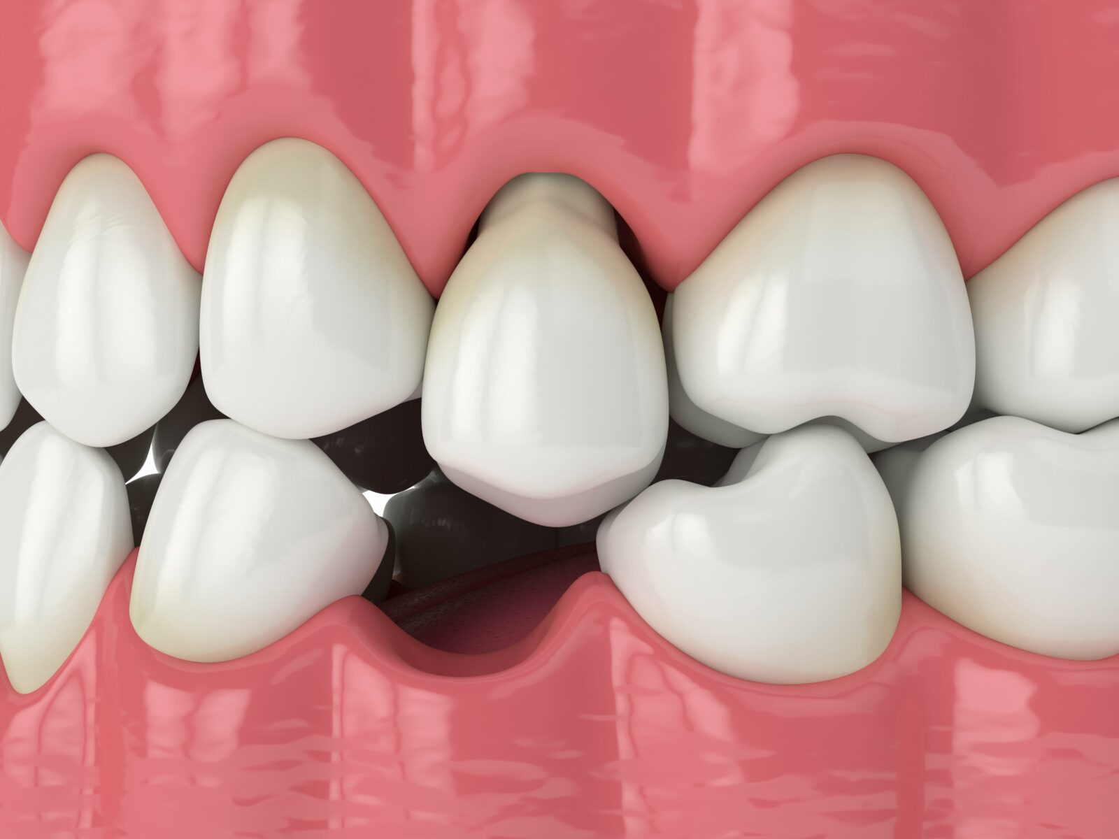 5 Reasons to Replace Missing Teeth | Digital Denture + Implants | Los  Angeles, CA