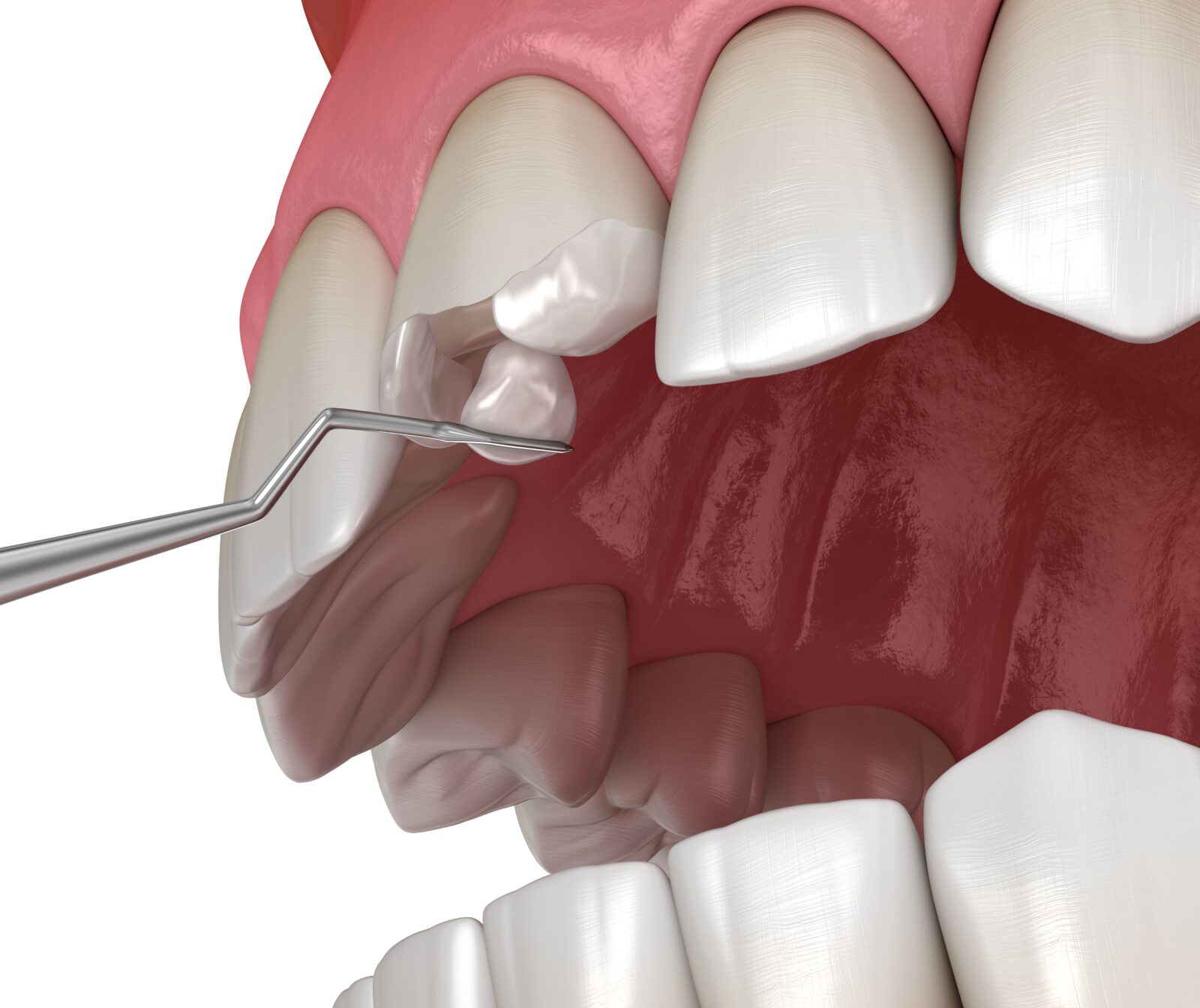 composite bonding being used on a broken tooth