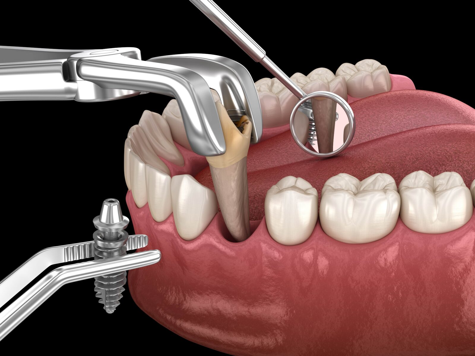 extracting tooth and placing dental implant