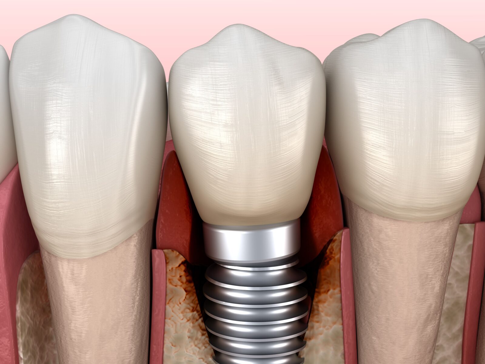 infected dental implant