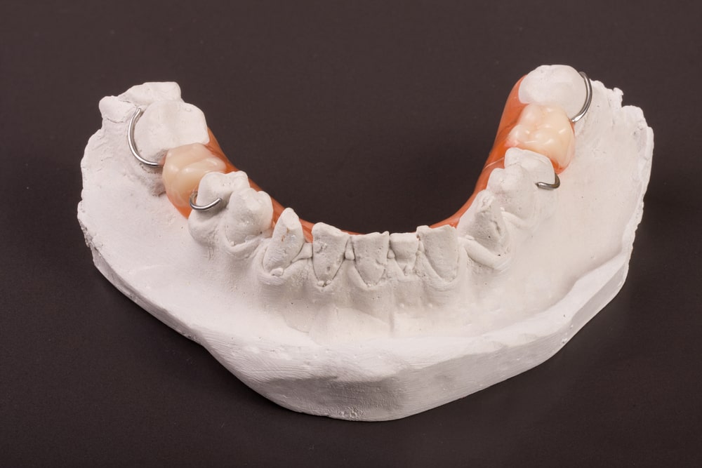 partial denture shown on model of teeth