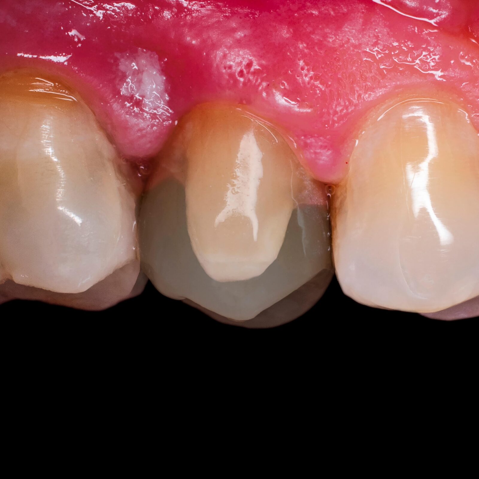 dental restoration showed overlapping a small tooth