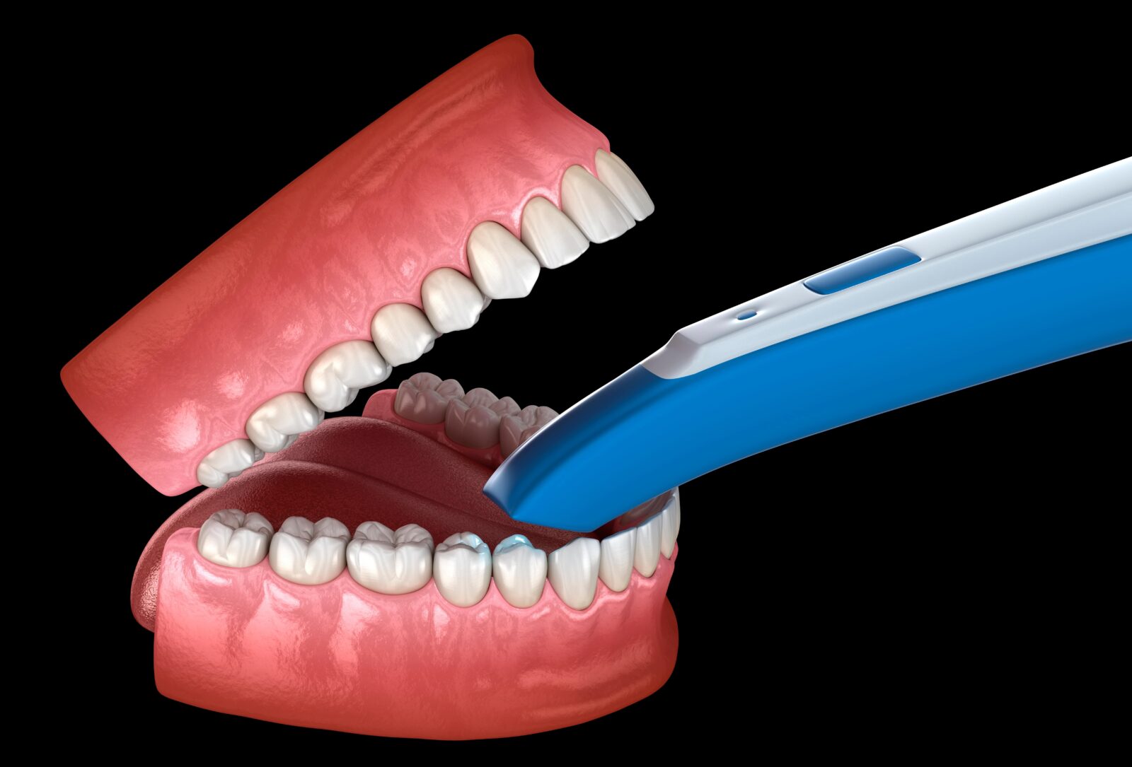 Advantages Of Digital Dental Impression Technology | Digital Denture ...